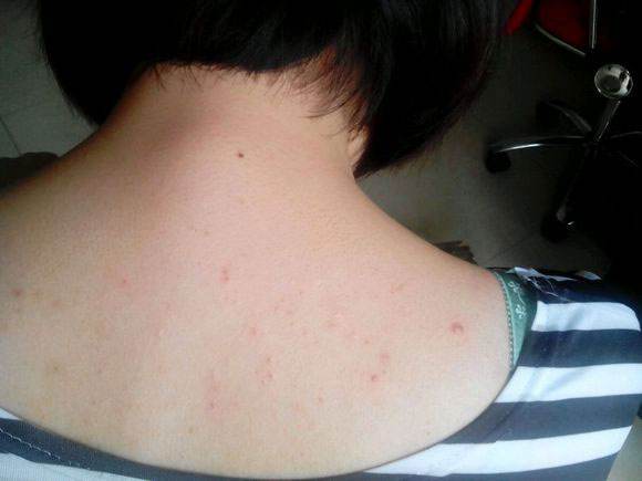 后背痘痘肌